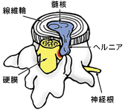 椎間板ヘルニア