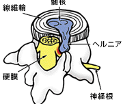 椎間板ヘルニア